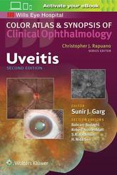  Uveitis