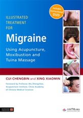  Illustrated Treatment for Migraine Using Acupuncture, Moxibustion and Tuina Massage