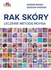 Rak skóry Leczenie metodą Mohsa